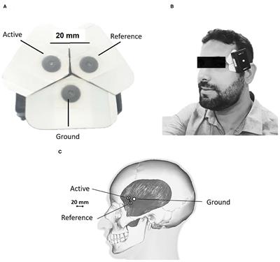 Electromyographic Patterns and the Identification of Subtypes of Awake Bruxism